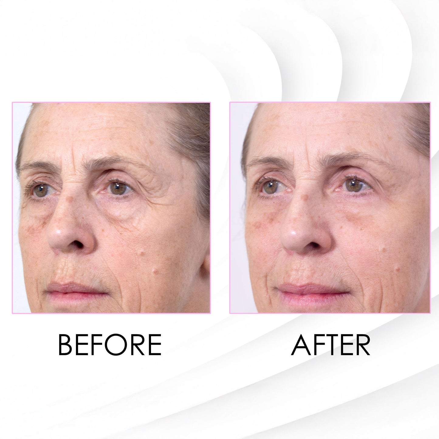 Wrinkle Killer Instant Face Lift 5 x 2ml