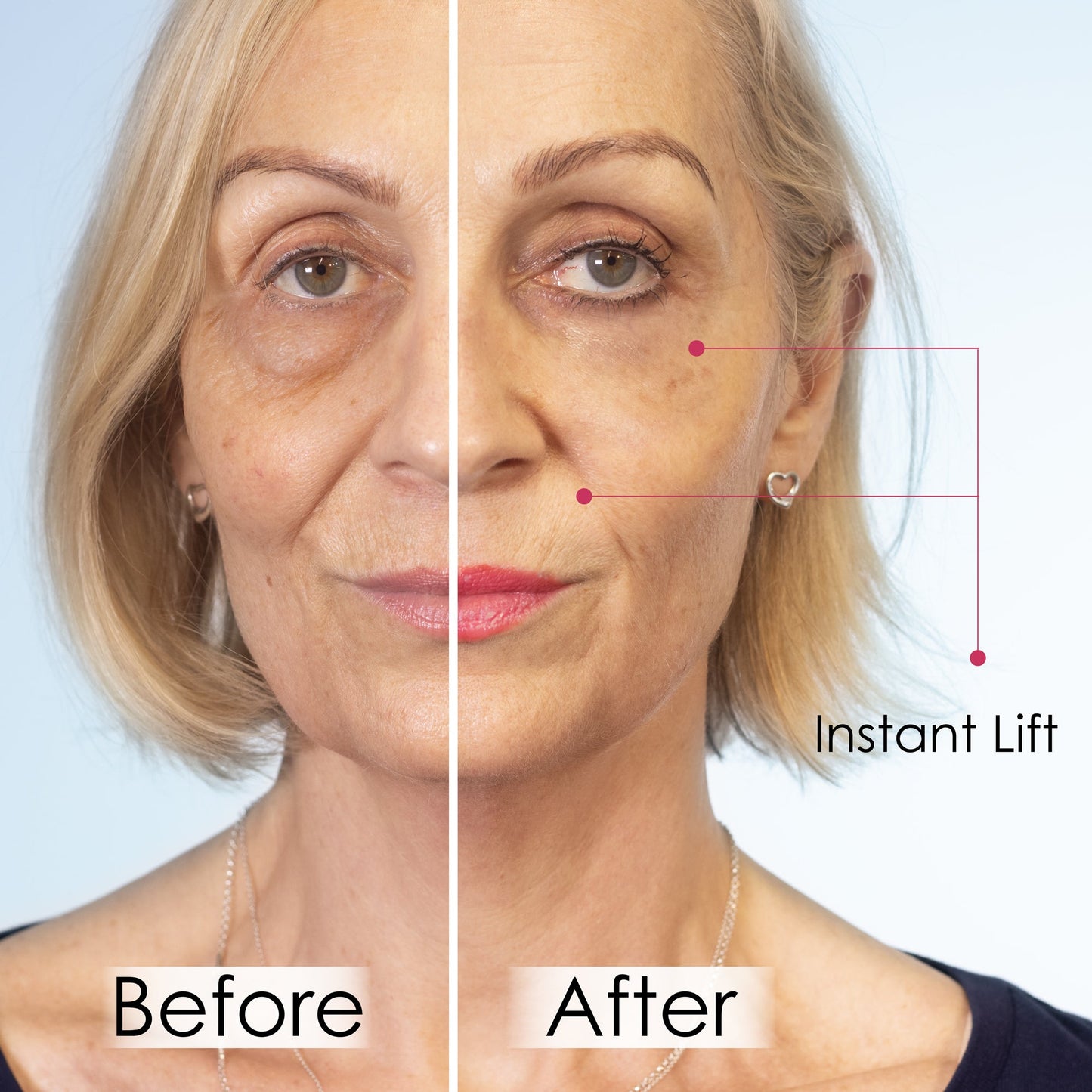 Wrinkle Killer Instant Face Lift 5 x 2ml